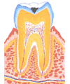 虫歯イメージ