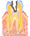 虫歯イメージ