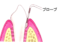 歯周病イメージ